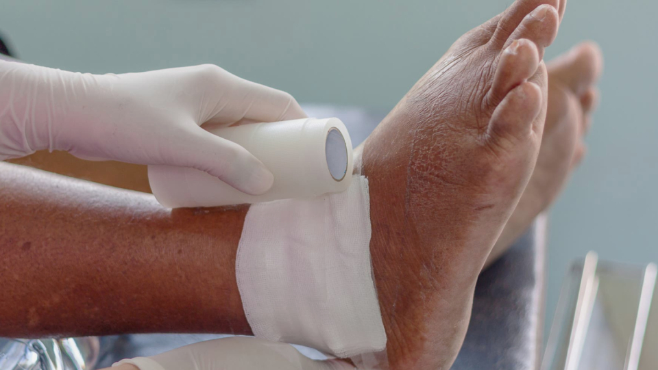 Chronic wounds are frequently difficult to treat. Absorbable foam should act as a bandage because it promotes wound healing particularly well.