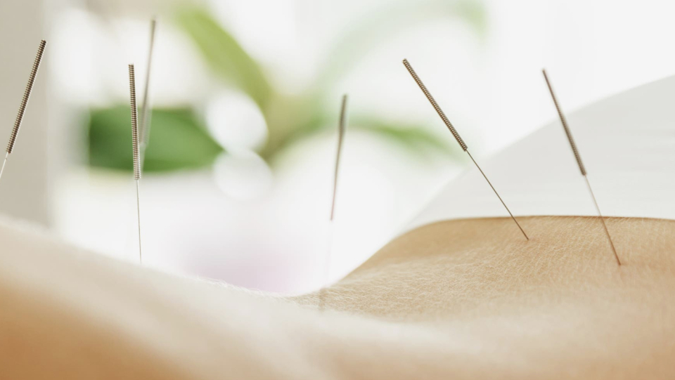 Whether it's back pain, arthritis or migraine – if nothing helps anymore, acupuncture should fix it. But scientific evidence is scarce. the endeavor of classification.