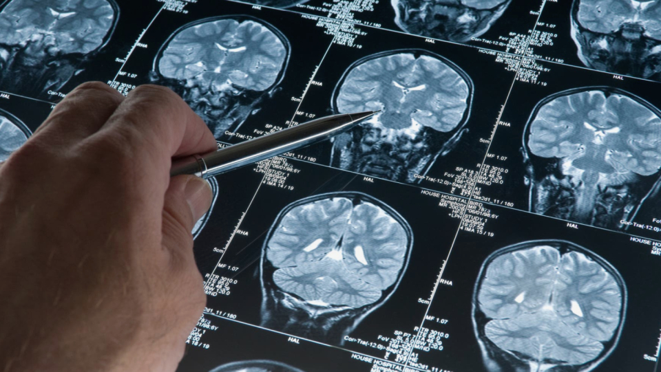 A working group demonstrates in detail how the brain evolves during life with 120,000 MRI scans. It took diplomatic skill to obtain the info.