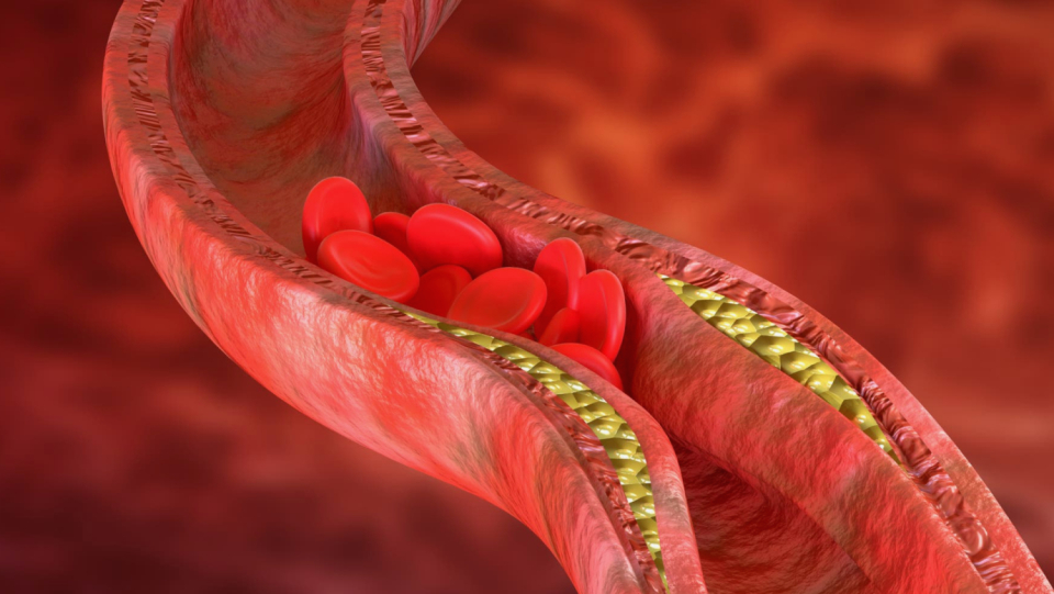 Previously, it was thought that atherosclerosis was a pure disease of blood vessels. But in fact, the vascular damage communicates with the brain.